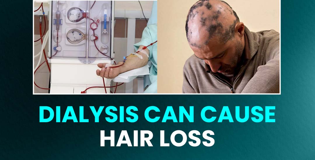 Why Dialysis Can Cause Hair Loss and What You Can Do About It?
